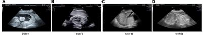 DilatedFormer: dilated granularity transformer network for placental maturity grading in ultrasound